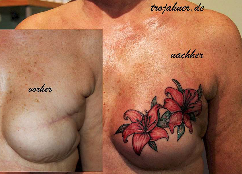 Bild Mamillen Areola Rekonstruktion und Narbenüberdeckung durch Tattoo
