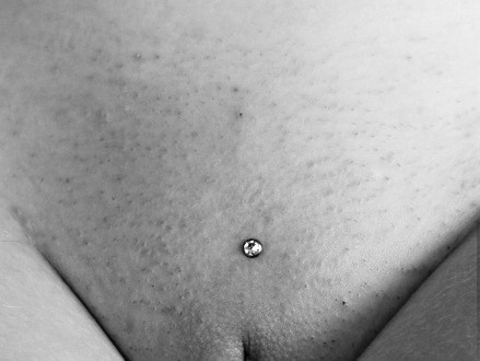 Bild Venushügel Dermal Anchor Piercing