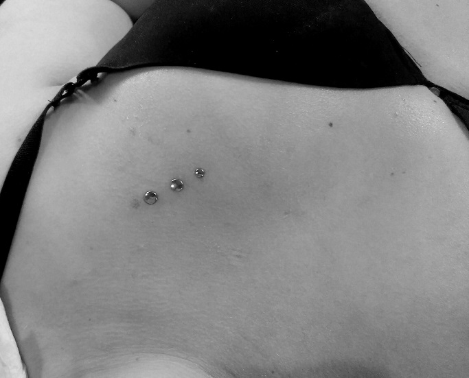 Bild Brusthautanker Dermal Anchor Implant