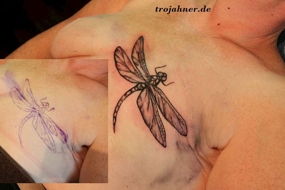 Bild Libelle über Narbe nach Brustkrebs OP