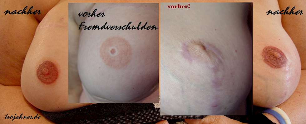 Bild Brustwarzenpigmentierung Brustwarzentätowierung nach Brustkrebs OP