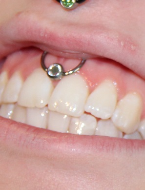 Bild Lippenbändchenpiercing Piercing mit Titanschmuck in Dresden stechen piercen lassen.