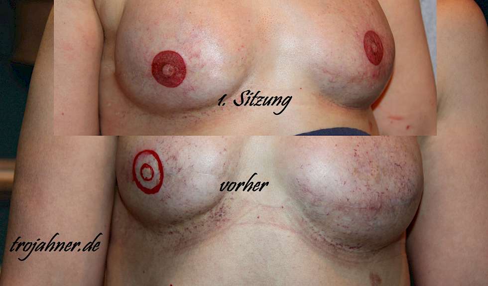 Bild Mamillen Brustwarzenpigmentierung medizinische Pigmentierung Tätowierung