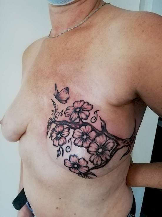 Bild Mamillen Areola Rekonstruktion und Narbenüberdeckung durch Tattoo