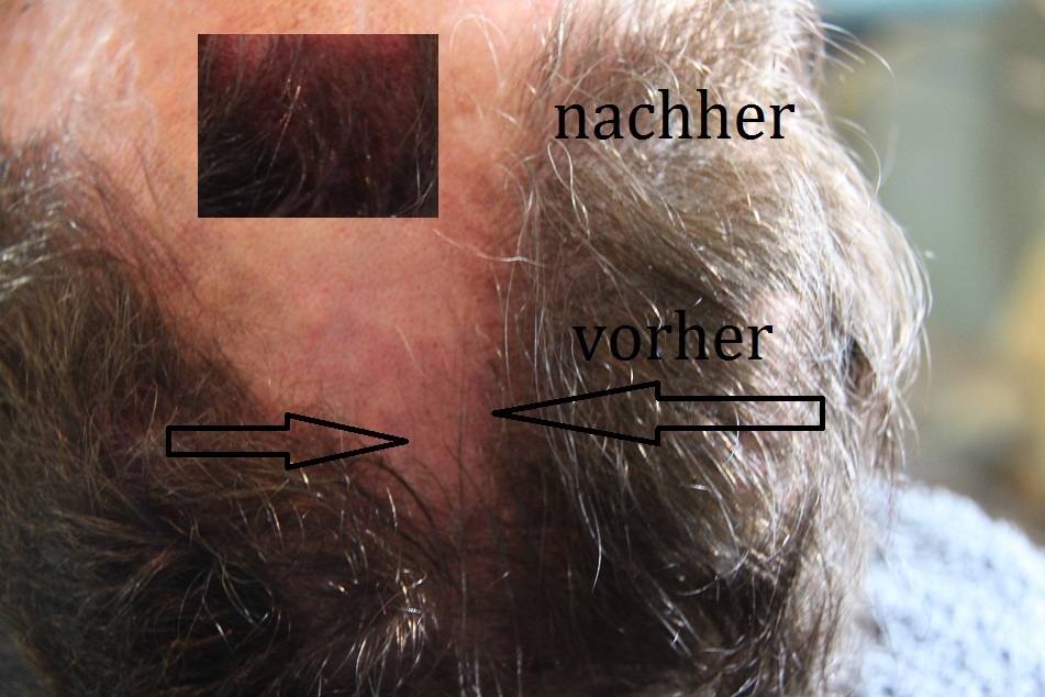 Test ca 2x2cm groß Preis 150 Euro Bild Hairtattoo Haar Tätowierung Haarstoppel Kopfhaartattoo Kopfhaartätowierung Kopfhaar Geheimratsecken tätowieren