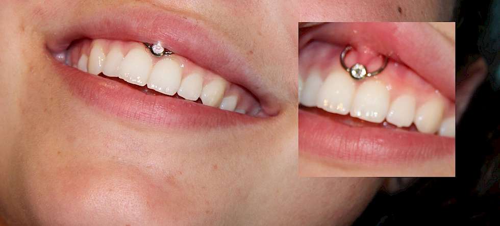 Lippenbändchen Piercing mit Titanring und Steinchen platte Form Piercing Dresden Bild Piercing